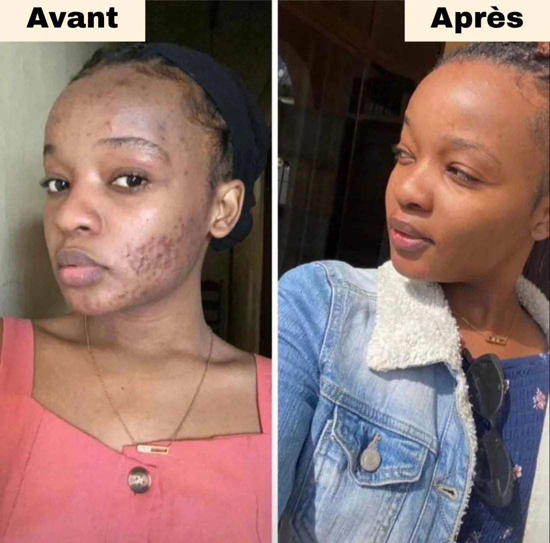 Cotons au Curcuma Anti-Imperfections(60 Pads)